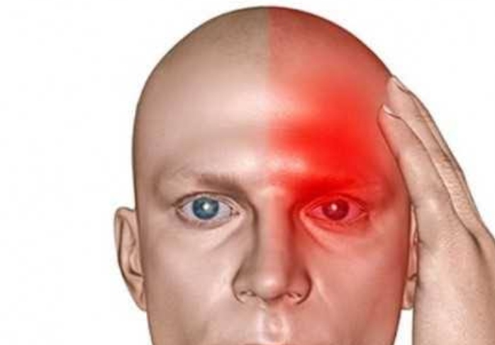 Kenali Penyebab-penyebab Migrain